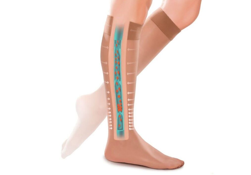 ang epekto sa compression stockings sa mga bitiis nga adunay varicose veins