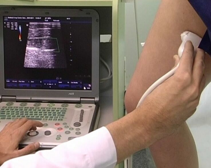 ultrasound diagnosis sa pelvic varicose veins