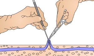 operasyon alang sa varicose veins