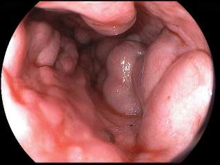 varicose veins sa esophagus