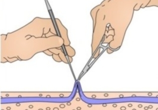 varicose veins surgical pagtambal